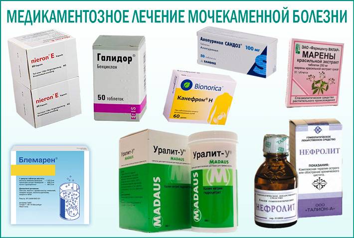 Камни почек. что нужно знать и как правильно лечить