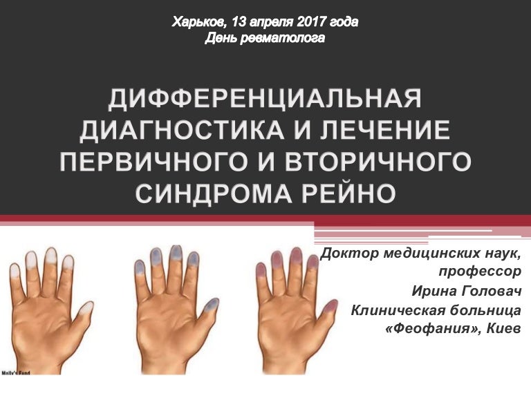 Синдром рейно