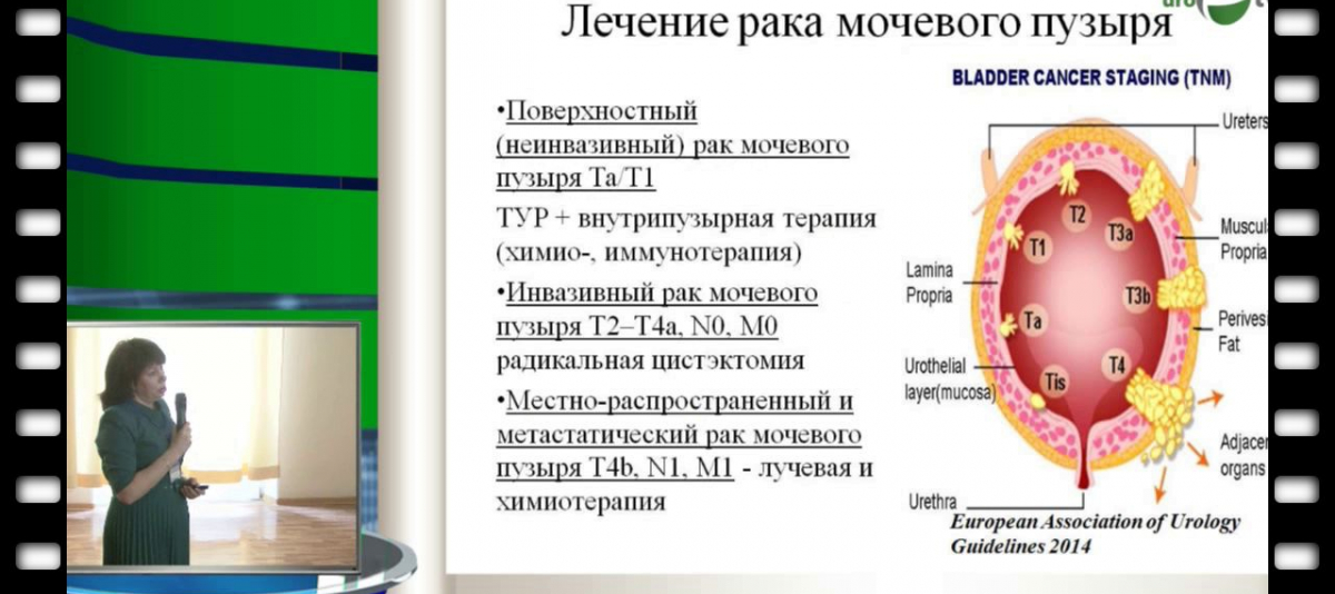 Лечение рака мочевого пузыря в ведущих центрах и клиниках германии
