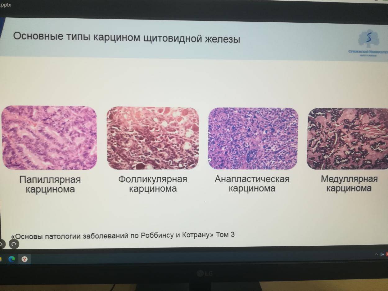 Узловой зоб